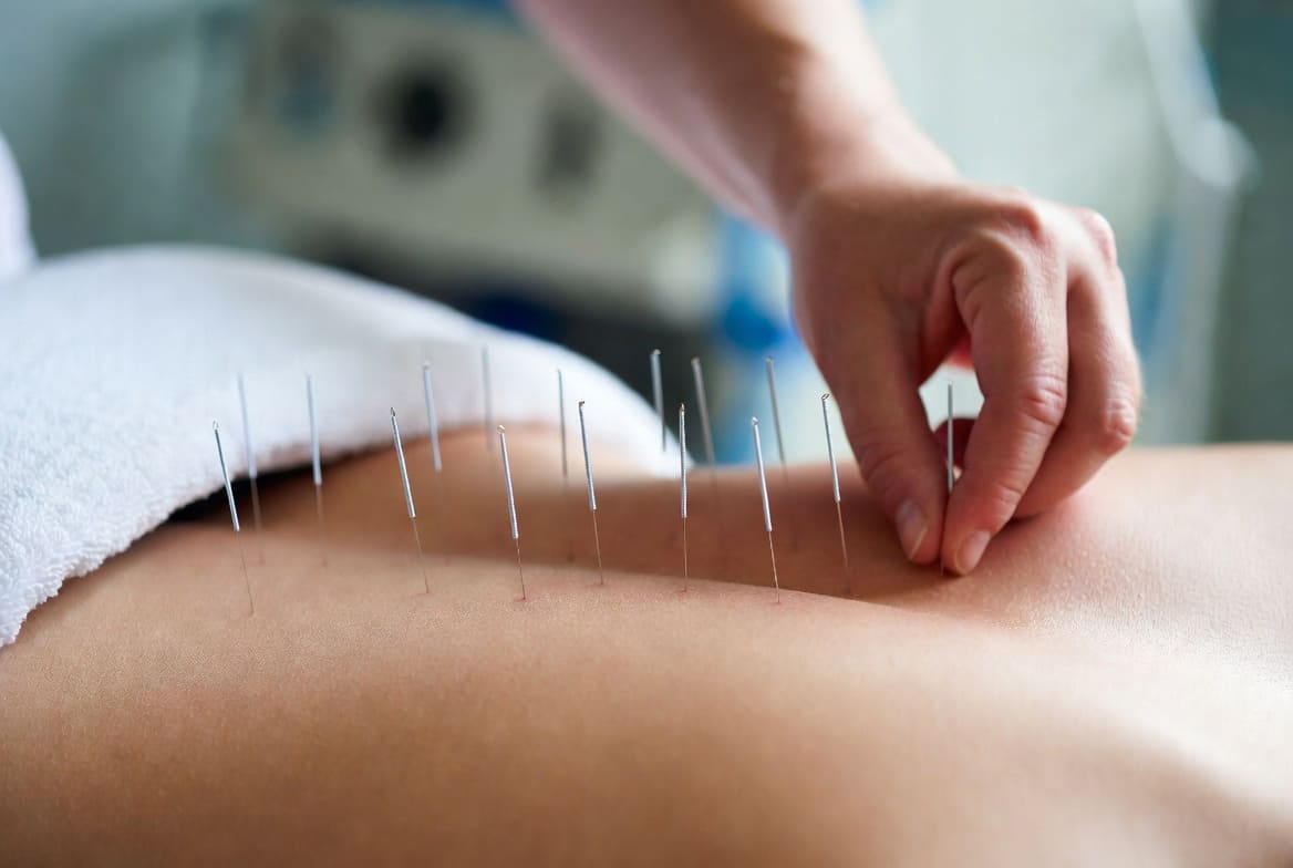 Пациент на сессии иглоукалывания с доктором